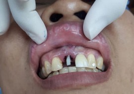[Video 1] cắm ghép Implant tại Nha khoa Én Trắng