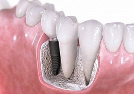 Cắm ghép Implant hoàn toàn không đau