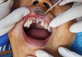 [Video 4] Cắm ghép Implant tại Nha khoa Én Trắng