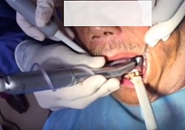 [Video 5] Cắm ghép Implant tại Nha khoa Én Trắng