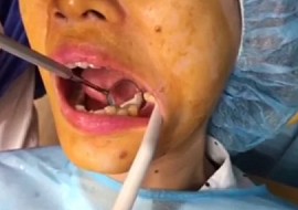 [Video 7] Cắm ghép Implant tại Nha khoa Én Trắng