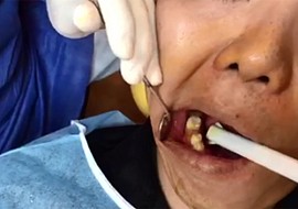 [Video 2] cắm ghép Implant tại Nha khoa Én Trắng