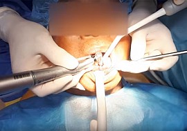 [video 3] Cắm ghép Implant tại Nha khoa Én Trắng