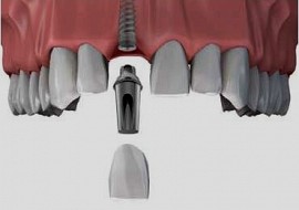 Vì sao nên chọn Implant trong các phương pháp điều trị phục hồi khi mất răng?