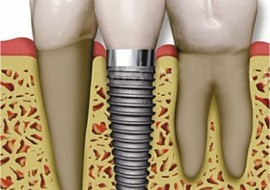 Implant cho người cao tuổi