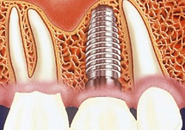 Cắm Implant có biến chứng gì không?