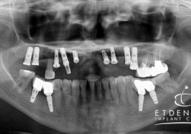 Răng có thể không nghe môi mà rời khỏi miệng bất cứ lúc nào!!!