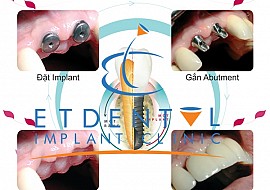 AN TOÀN VÔ TRÙNG TRONG CẤY GHÉP IMPLANT TẠI NHA KHOA ÉN TRẮNG – phần 2
