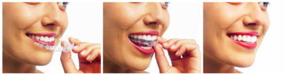 chinh nha khong mac cai - INVISALIGN