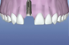 Cắm implant