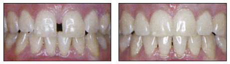 điều trị invisalign