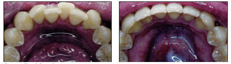 invisalign