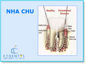 Điều trị nha chu