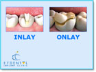 INLAY-ONLAY