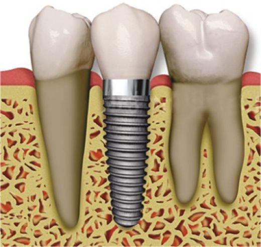 Cấy ghép implant