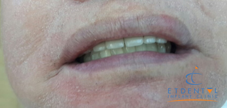 Hình ảnh sau khi hoàn tất điều trị