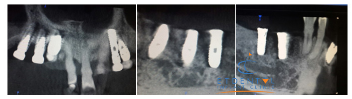 Phim chụp CT 3 chiều sau cắm ghép Implant