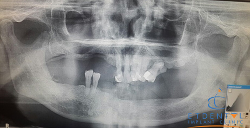 Phim chụp toàn cảnh trước điều trị